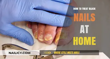 Effective Home Remedies for Treating Black Nails Naturally and Safely