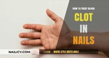 Effective Remedies for Treating Painful Blood Clots Under Fingernails