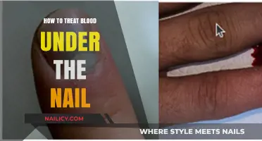 Effective Ways to Treat Blood Under the Nail: Quick Relief Tips