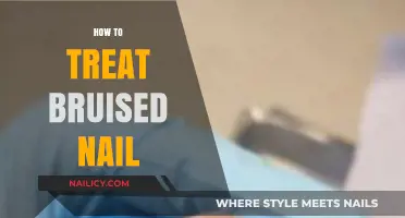 Effective Remedies for Healing and Soothing a Bruised Nail