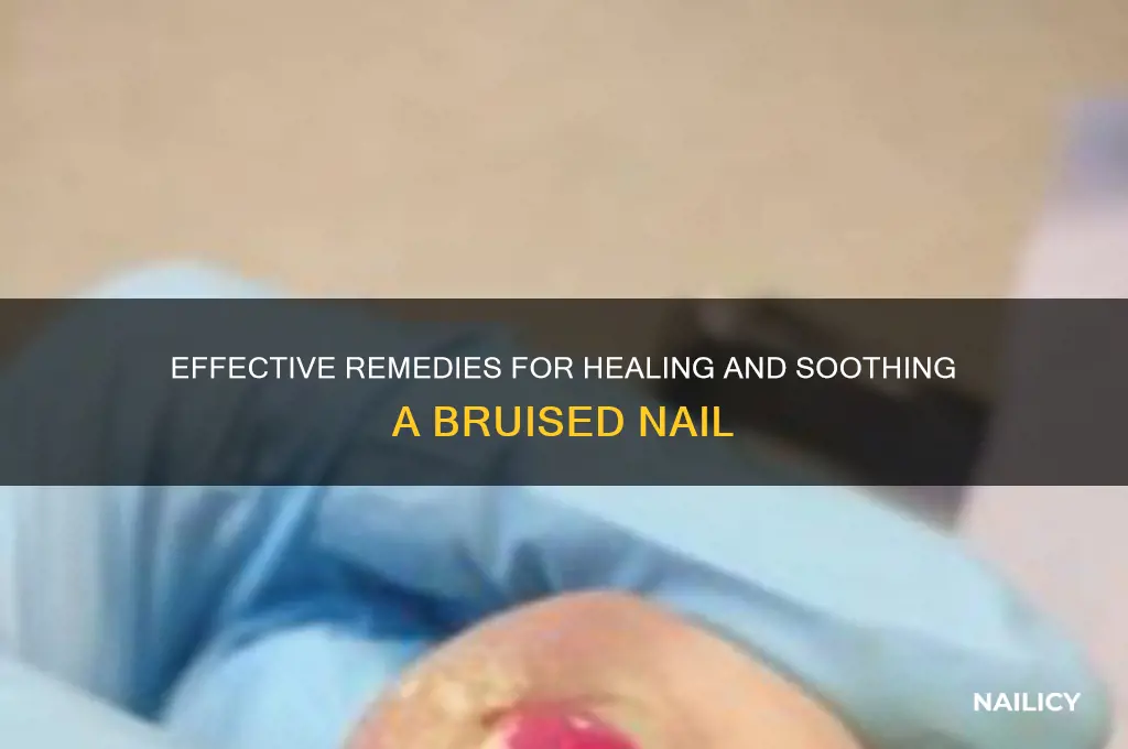how to treat bruised nail