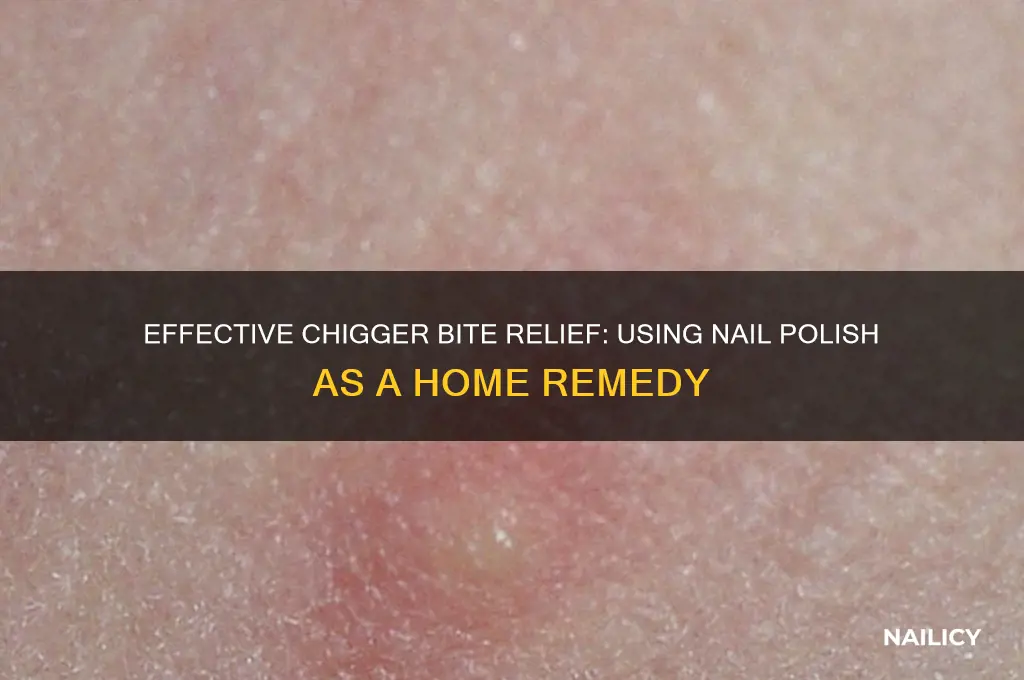 how to treat chigger bites nail polish