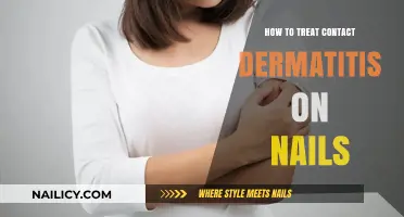 Effective Treatment Strategies for Contact Dermatitis on Nails: A Guide