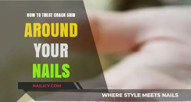 Heal and Prevent Cracked Skin Around Nails: Effective Care Tips