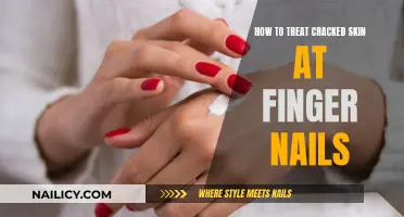 Heal Cracked Skin Around Nails: Effective Home Remedies
