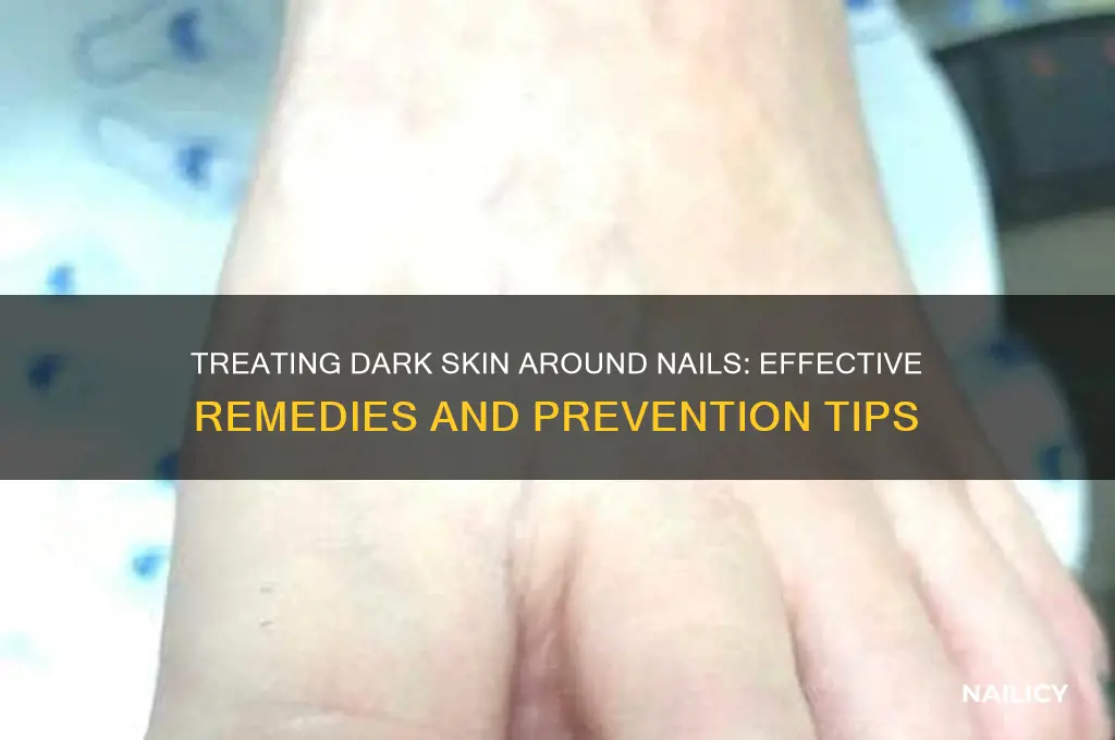 how to treat dark skin around nails