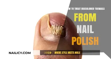 Revive Your Toenails: Effective Treatments for Nail Polish Discoloration