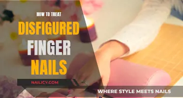 Treating Disfigured Nails: Expert Tips for Healthy Fingers