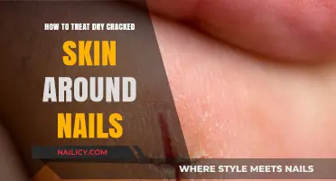 Heal Dry, Cracked Skin Around Nails: Effective Remedies and Tips