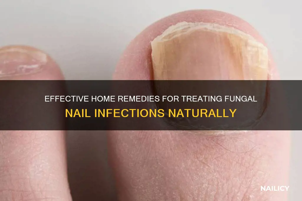 how to treat fungal nail at home