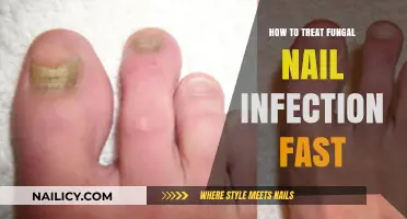 Effective Remedies for Quick Fungal Nail Infection Treatment and Relief
