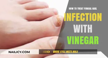 Effective Vinegar Remedies for Treating Fungal Nail Infections at Home