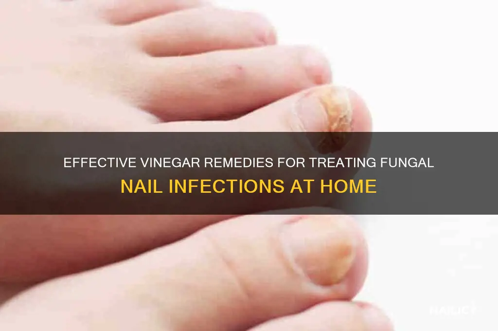how to treat fungal nail infection with vinegar