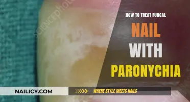 Effective Treatment for Fungal Nail Infections with Paronychia Complications