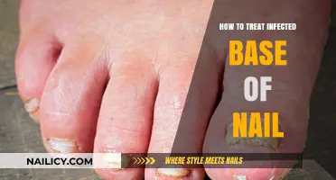 Effective Treatment Tips for Healing an Infected Nail Base
