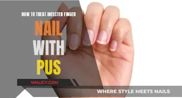 Treating an Infected Fingernail: Managing Pus and Pain