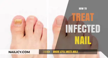 Effective Treatment Strategies for Healing Infected Nails at Home