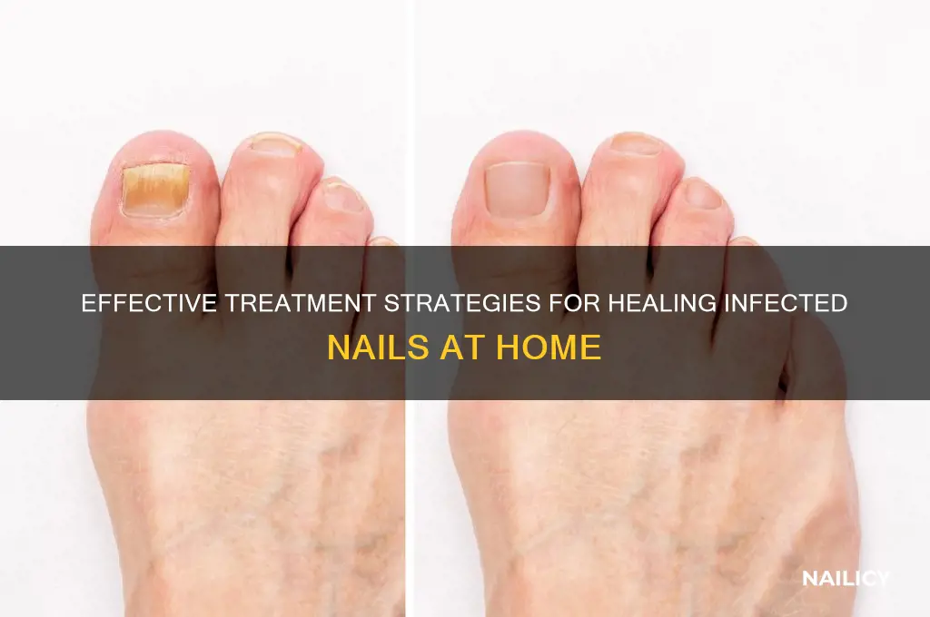 how to treat infected nail
