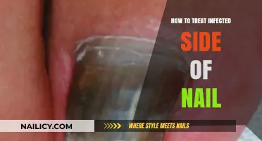 Effective Home Remedies and Treatments for Infected Nail Side Relief