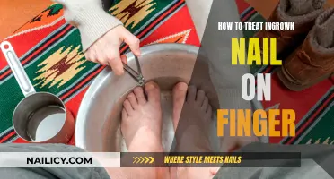 Ingrown Nail Relief: Quick Tips for Comfort and Healing