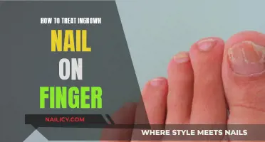 Treating Ingrown Nails: Home Remedies and Professional Care