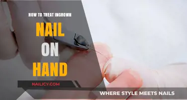 Effective Home Remedies and Treatments for Ingrown Hand Nails