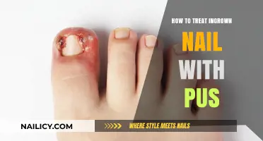 Effective Home Remedies and Treatments for Ingrown Toenails with Pus