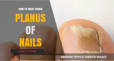 Effective Treatment Strategies for Lichen Planus of Nails: A Comprehensive Guide