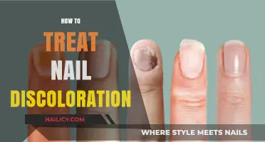 Effective Remedies for Treating and Preventing Nail Discoloration