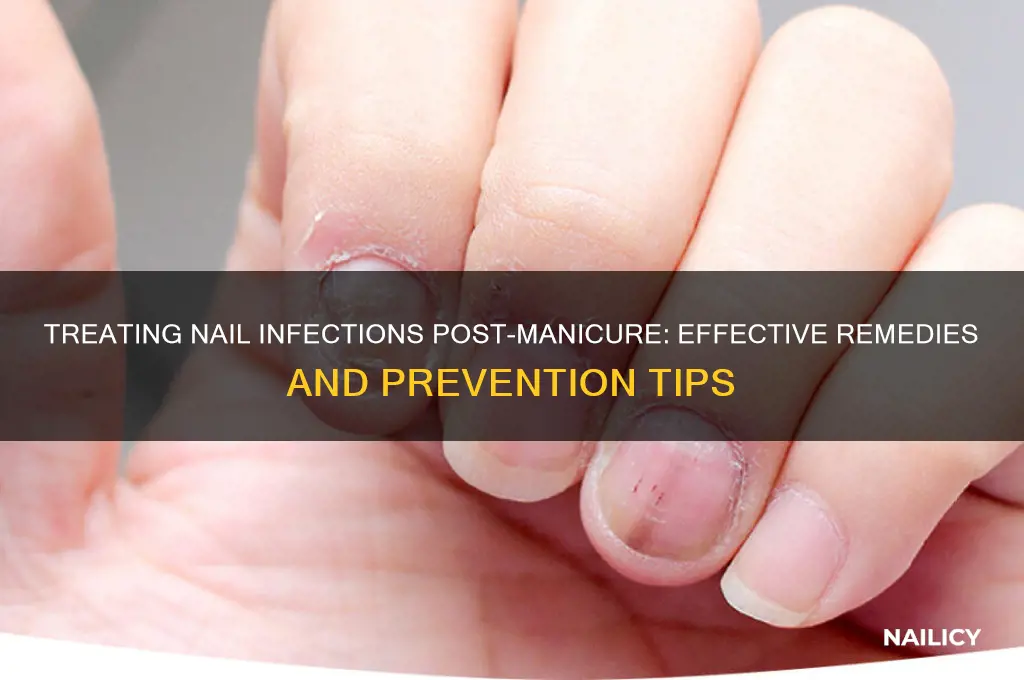how to treat nail infection after manicure