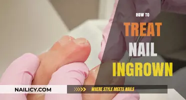 Effective Remedies for Painful Ingrown Toenails: A Comprehensive Guide