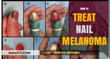 Treating Nail Melanoma: A Comprehensive Guide to Early Detection and Effective Therapies