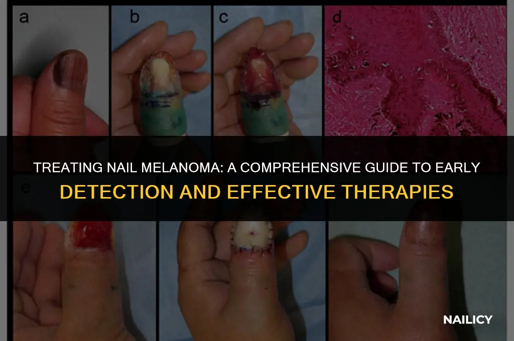 how to treat nail melanoma