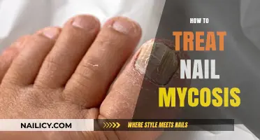 Effective Ways to Treat Nail Mycosis: A Comprehensive Guide