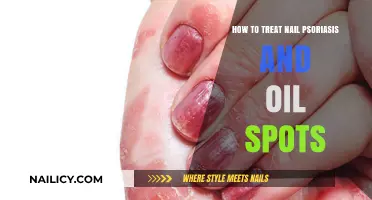 Effective Nail Psoriasis and Oil Spot Treatment Tips and Remedies