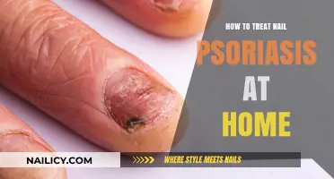 Effective Home Remedies for Managing Nail Psoriasis Naturally