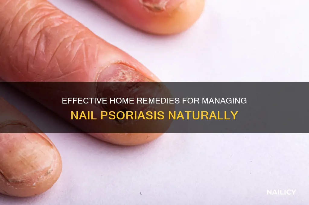 how to treat nail psoriasis at home