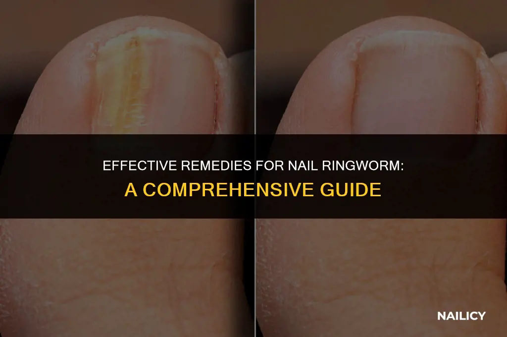 how to treat nail ringworm