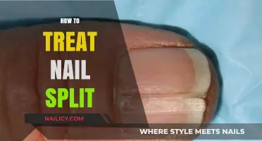 Effective Remedies for Treating Painful Nail Splits at Home
