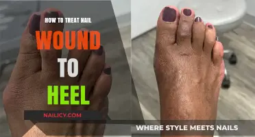 Healing Nail Wound on Heel: Effective Treatment Tips and Care Guide