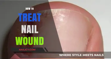 Effective Ways to Treat a Painful Nail Wound at Home