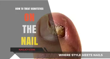 Effective Treatment Strategies for Onychomycosis: Clear Nail Fungus Fast