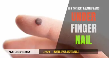 Treating Palmar Warts Under Fingernails: Effective Home Remedies