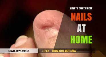 Effective Home Remedies for Treating Pincer Nails Naturally and Safely