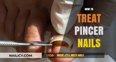Effective Remedies for Painful Pincer Nails: A Comprehensive Guide