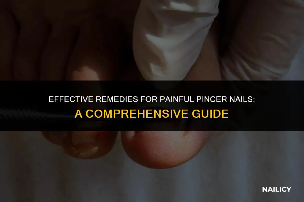 how to treat pincer nails