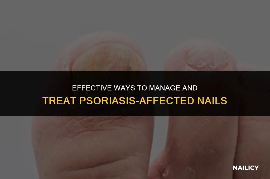 how to treat psoriasis nails
