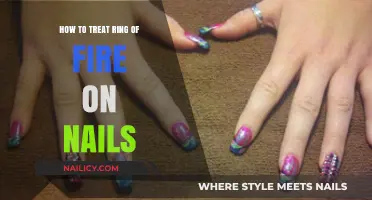 Effective Remedies for Treating Ring of Fire Nail Infections at Home