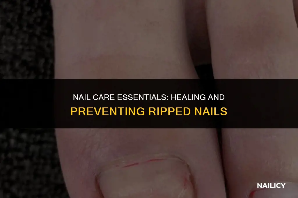 how to treat ripped nail