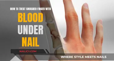 Treat Smashed Fingers: Drain Blood, Reduce Pain